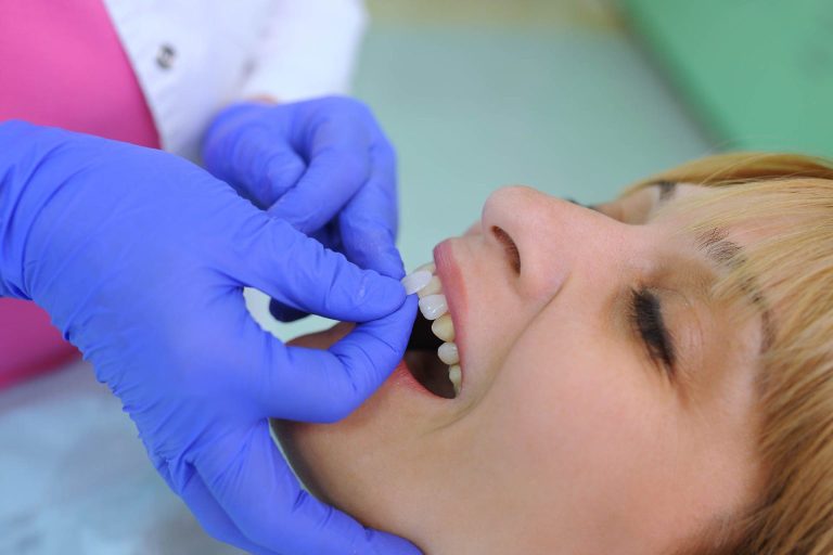Come si mettono le faccette per i denti?