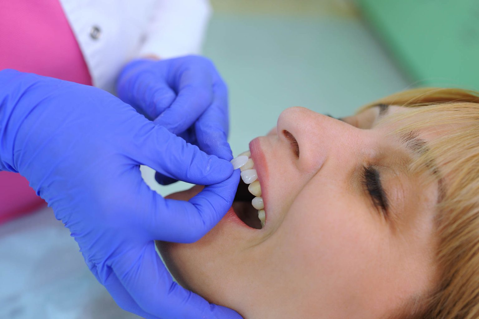 applicazione faccette dentali dentista bologna centro smm 1536x1024 1