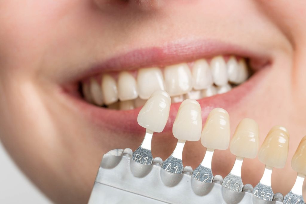 Cosa sono le faccette dentali?