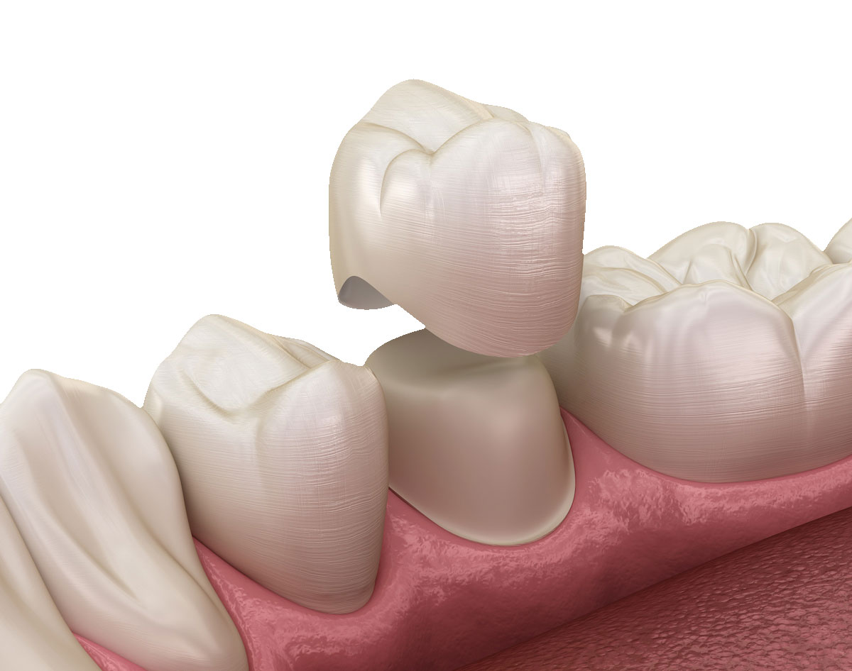 corona dentale centro smm dentista bologna