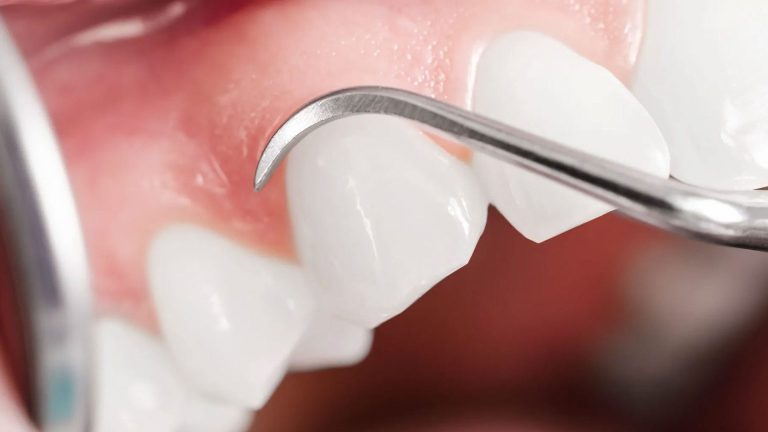 Curettage: Cos’è e quando viene fatto