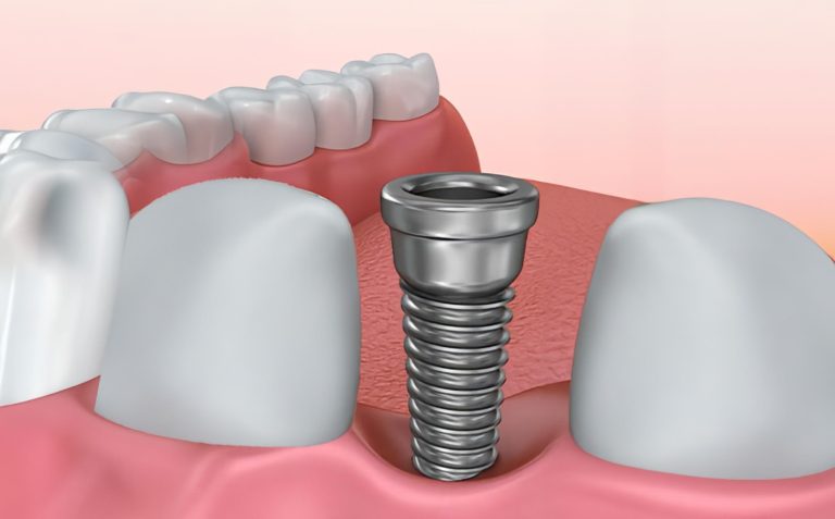 Come vengono fissati i denti sugli impianti?