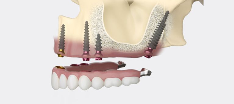 Implantologia senza osso: impianti dentali con poco osso mascellare