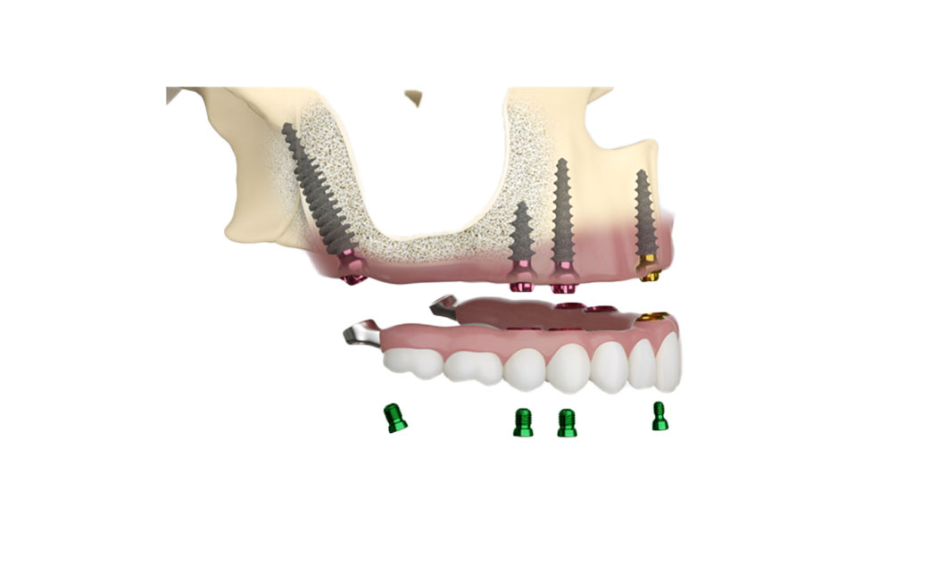 impianti pterigoidei dentista bologna centro smm