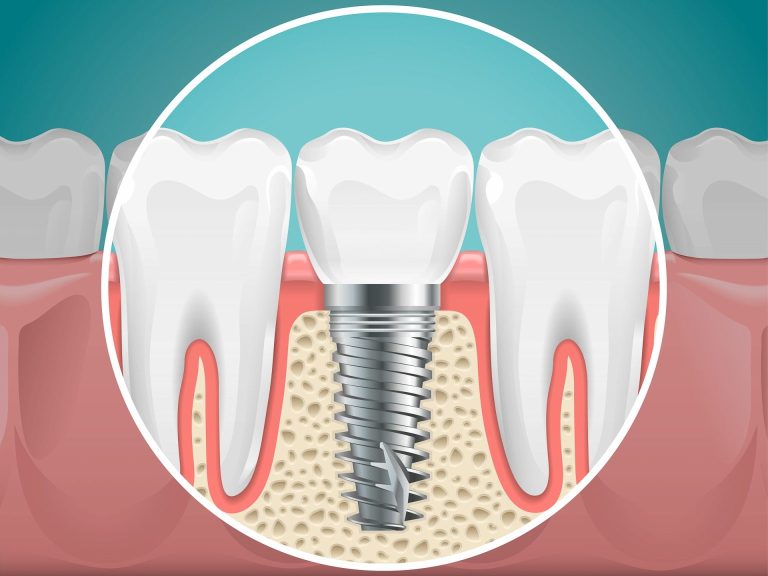 Che cos’è un impianto dentale?