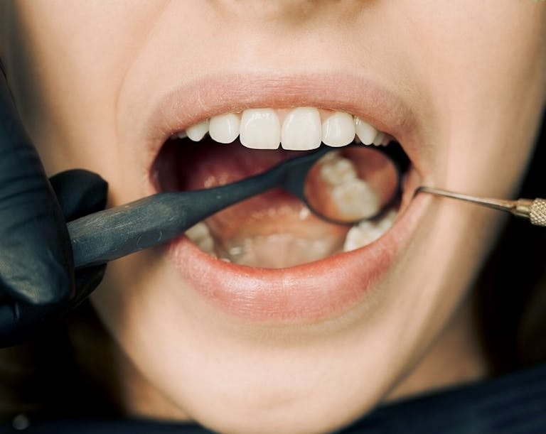 Come si cura la carie dentale?